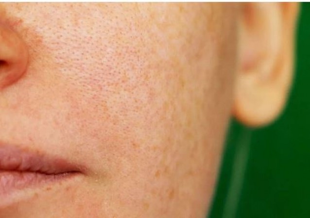 These 5 things will help in reducing open pores, your face will also start glowing