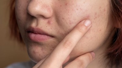 From pimples to swelling, these signs of liver damage are visible on the face and neck, check today