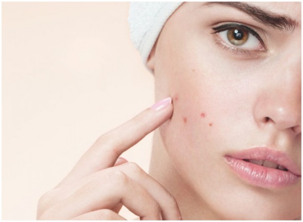 Keep acne at bay with These easy skincare hacks