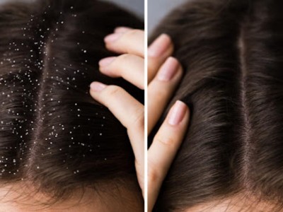 If you are having dandruff even in summer, then these 3 things will help you