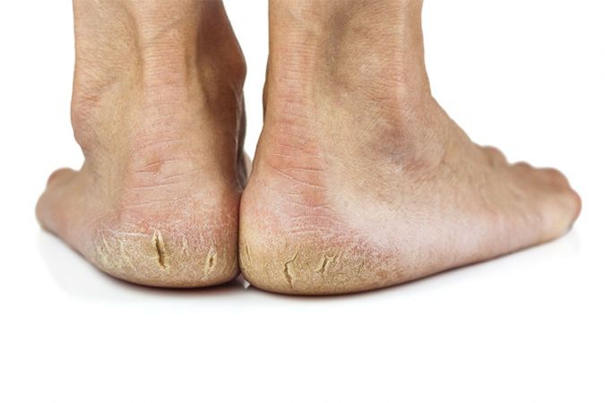 4 easy ideas to cure your cracked heels