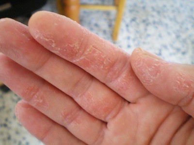 If the skin is peeling off from hands and feet, this could be the reason, get rid of it like this