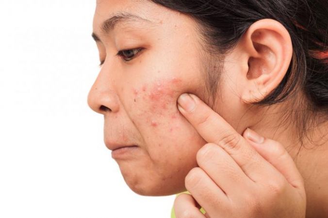 6 Habits that make your acne worse