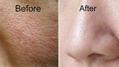 Know how to get rid of facial pores