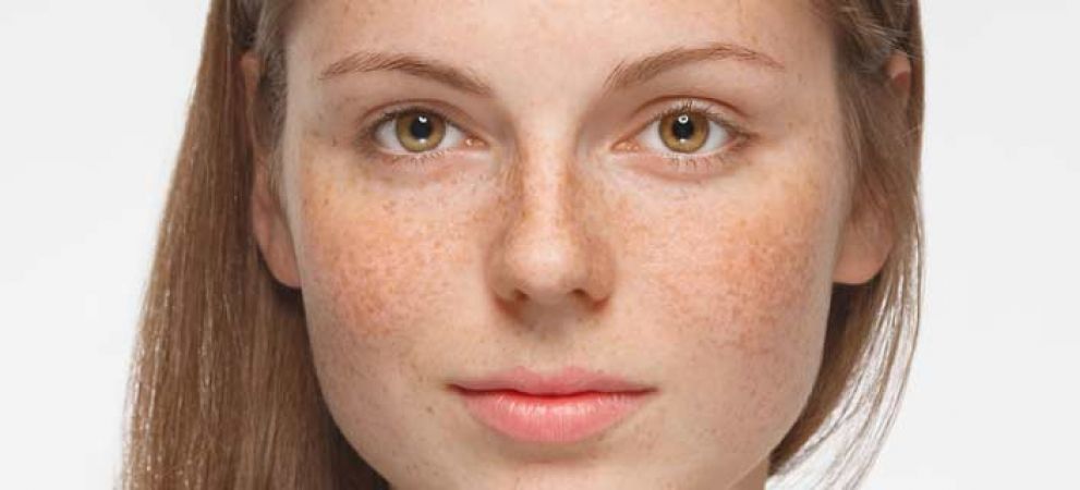 Easy approach to cure Hyperpigmentation