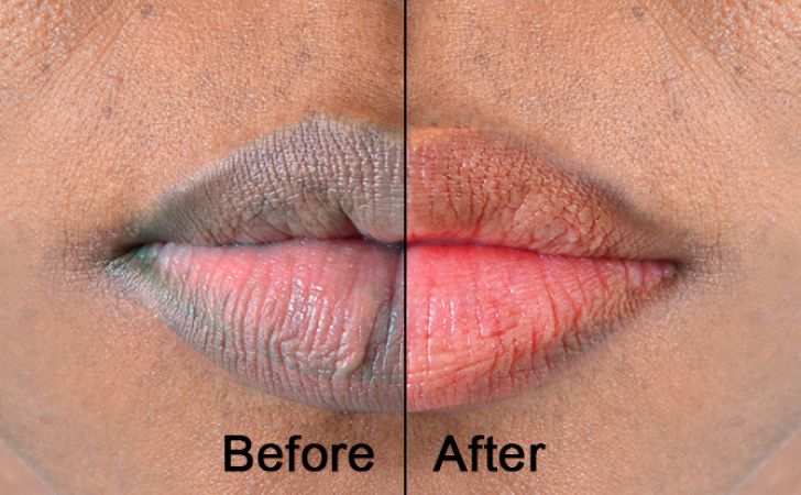 6 Home remedies to get rid of dark lips