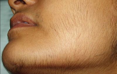 Follow these home remedies to remove unwanted hair permanently