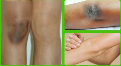 Effective and best remedies to lighten your elbow and knee