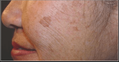 Homemade remedies to reduce age spot in best and effective way
