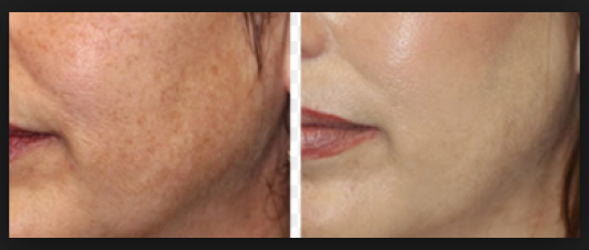 Dark spot and Pigmentation: Natural home remedies help to glow