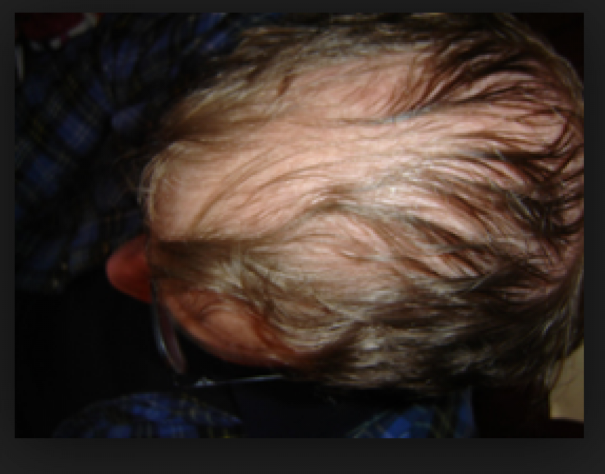 Hair Fall: Some important reasons may cause Hair fall