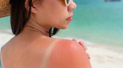 Do you fear sunburn in summer? So these 4 tips will save your skin