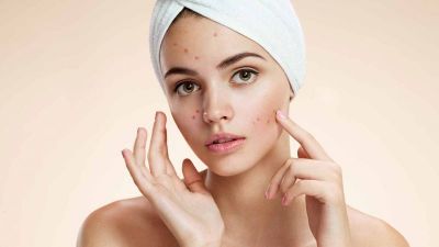 These easy tips will help you to remove the stubborn marks of pimples