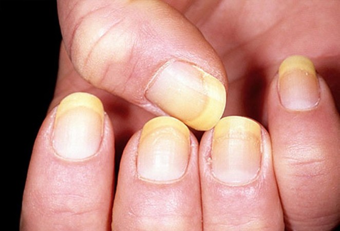 Yellow Nail: Yellowness starts accumulating in the hand nails, make your nails shine with these easy measures