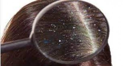 Why does dandruff occur in winter?