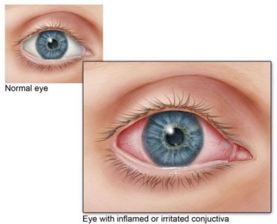 THESE TIPS WILL REMOVE EYE INFECTIONS