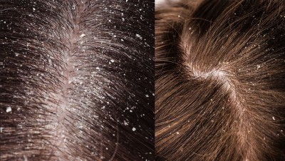 How to Banish Dandruff from Hair: These Effective Methods to Try at Home