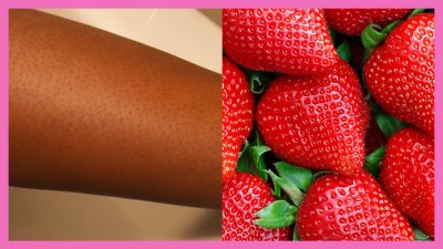 Know these natural Remedies to heal Strawberry Legs