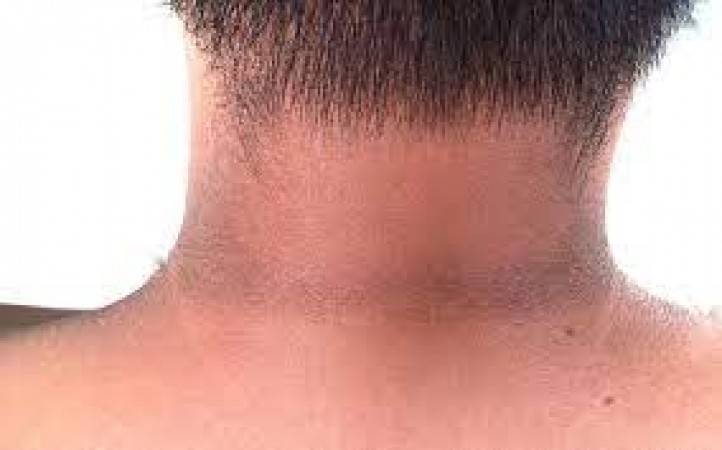 Has your neck turned black? Try these 5 easy remedies, you will get better results soon