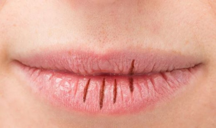 How to get rid of chapped lips