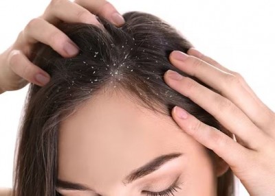 Dandruff problem started with increasing cold? Adopt these methods to prevent hair fall