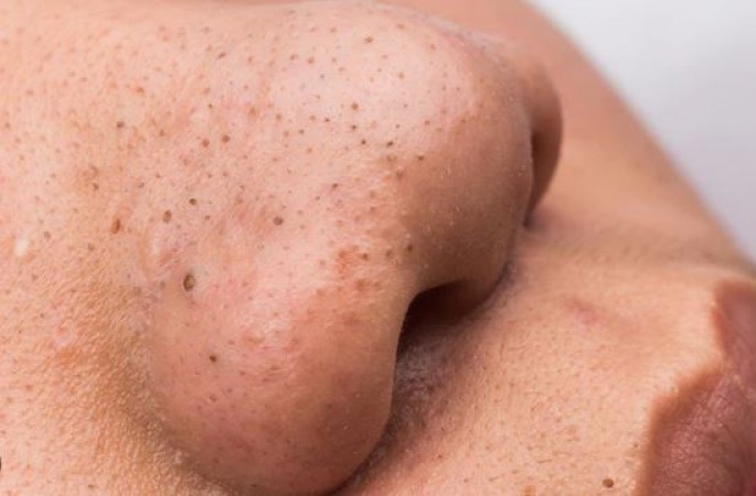 Remove blackheads from face easily, adopt this method