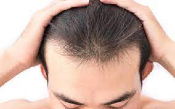 Does hair fall even after hair transplant? How safe is it and what things should be kept in mind, know from experts