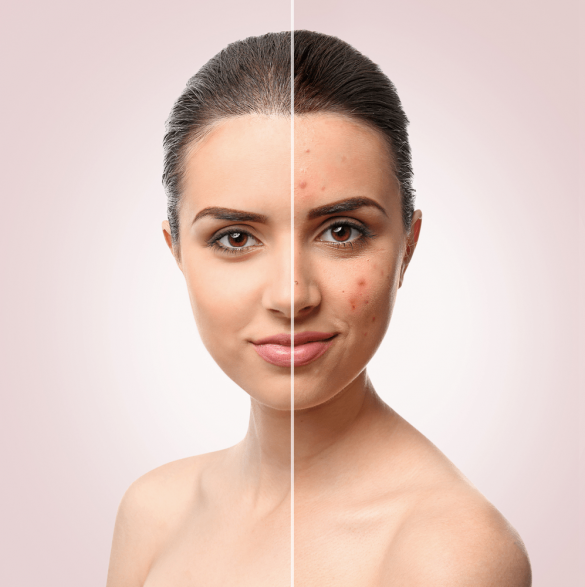Adopt these methods for healthy skin, all traces of acne will disappear