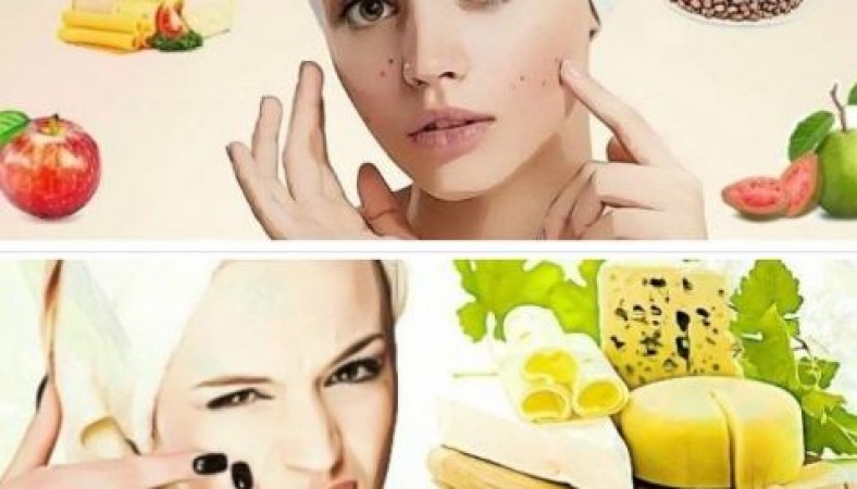 5 food items that cause Acne