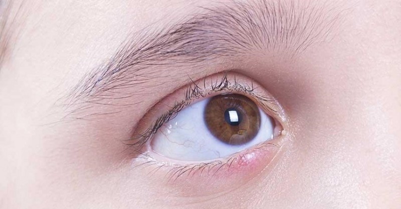 Here's How to Reduce Under-Eye Swelling with Home Remedies
