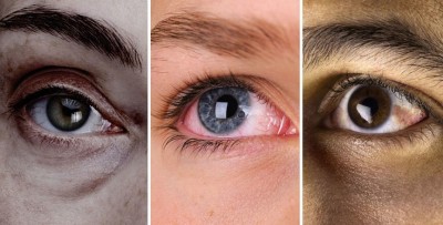 Shedding Light on Vision Care: Prevention of Blindness Week 2024, April 1-7