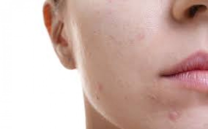 Why do pimples appear on the face before and after periods? What is the reason for this?