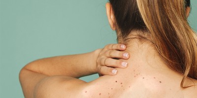 Do you have dark spots on your body?
