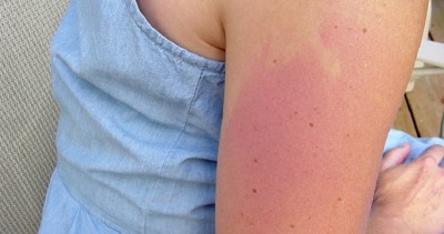 Summer Skin Care: How to Prevent and Manage Heat Rash