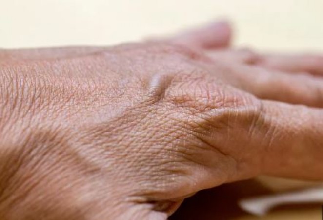 Hands are the mirror of health, bulging veins give warning, know the reason and treatment
