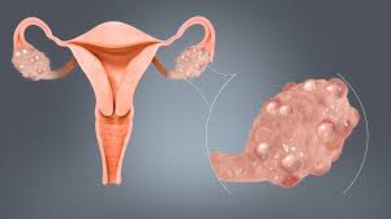 Why is PCOD disease increasing rapidly in women, know the reason