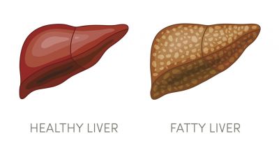 7 Causes of Fatty Liver disease