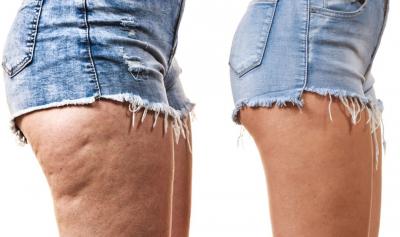 How to permanently get rid of cellulite in 5 steps