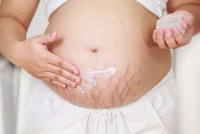 Are you troubled by stretch marks? These home remedies are enough to remove them!