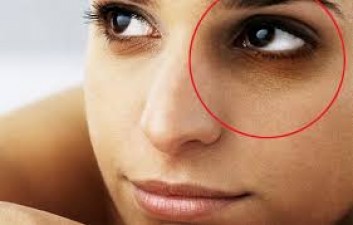Do dark circles indicate poor health? Is this a health problem?