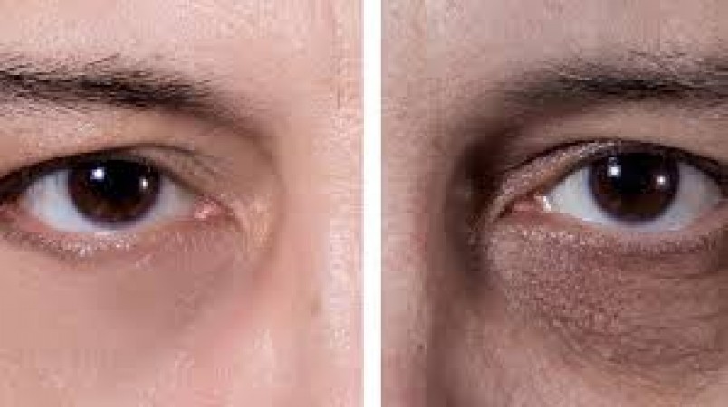 Apart from less sleep, dark circles can also occur due to these reasons