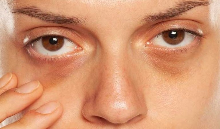 Dark Circles: Not Caused by Lack of Sleep, but by This