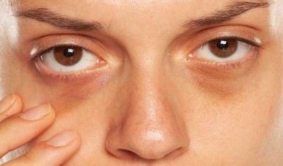 Dark Circles: Not Caused by Lack of Sleep, but by This