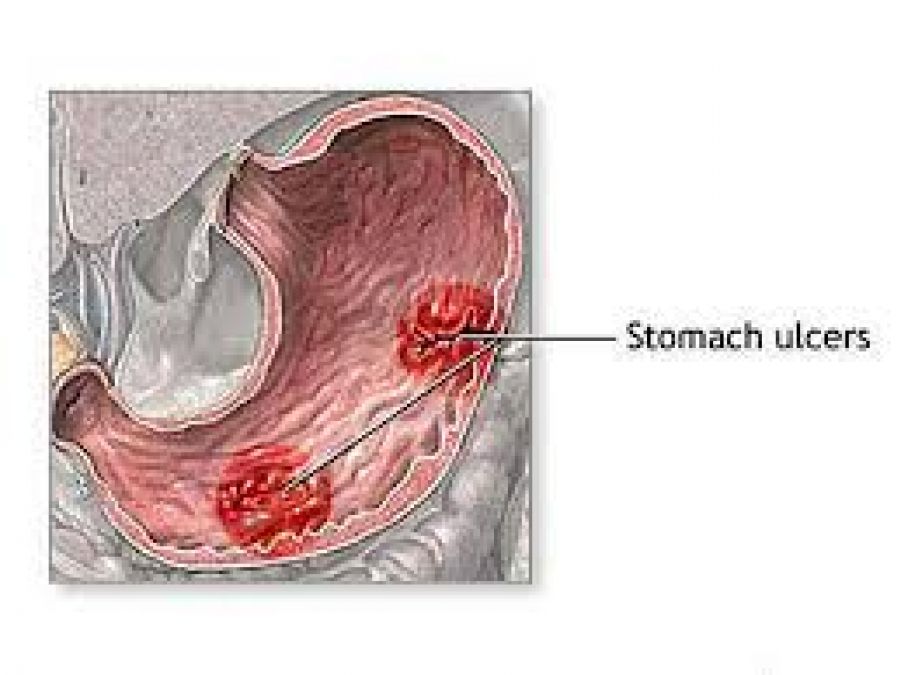 If you have stomach ulcers, then follow this home remedy