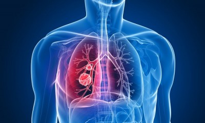 8 Tips to Reduce the Risk of Lung Cancer