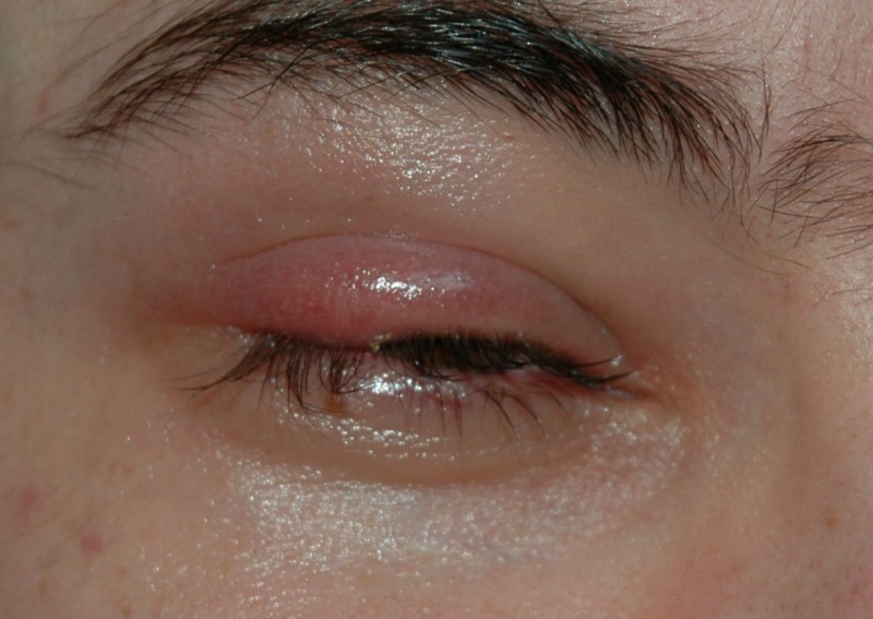 Warning Signs of Blepharitis: What to Watch for