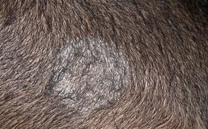 How to Identify and Treat Tinea Capitis (Ringworm)