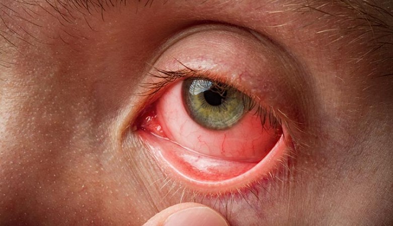 Conjunctivitis को रोकने के आसान तरीके