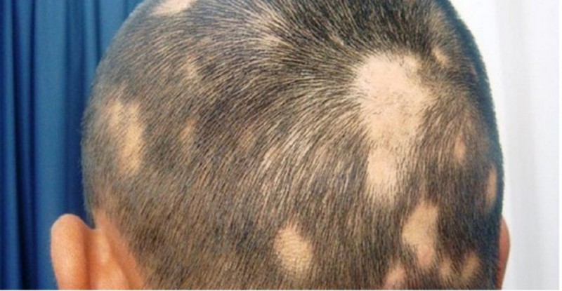How to Recognize and Seek Treatment for Scarring Alopecia