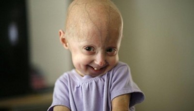Rare Genetic Disorders: Progeria, FOP, and Cockayne Syndrome